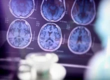 هوش مصنوعی با یک اسکن به تشخیص 9 نوع زوال عقل با دقت 88 درصدی کمک می‌کند